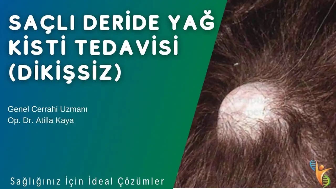 Saç Derisinde Yağ Bezesi Nedir, Belirtileri ve Etkili Tedavi Yöntemleri