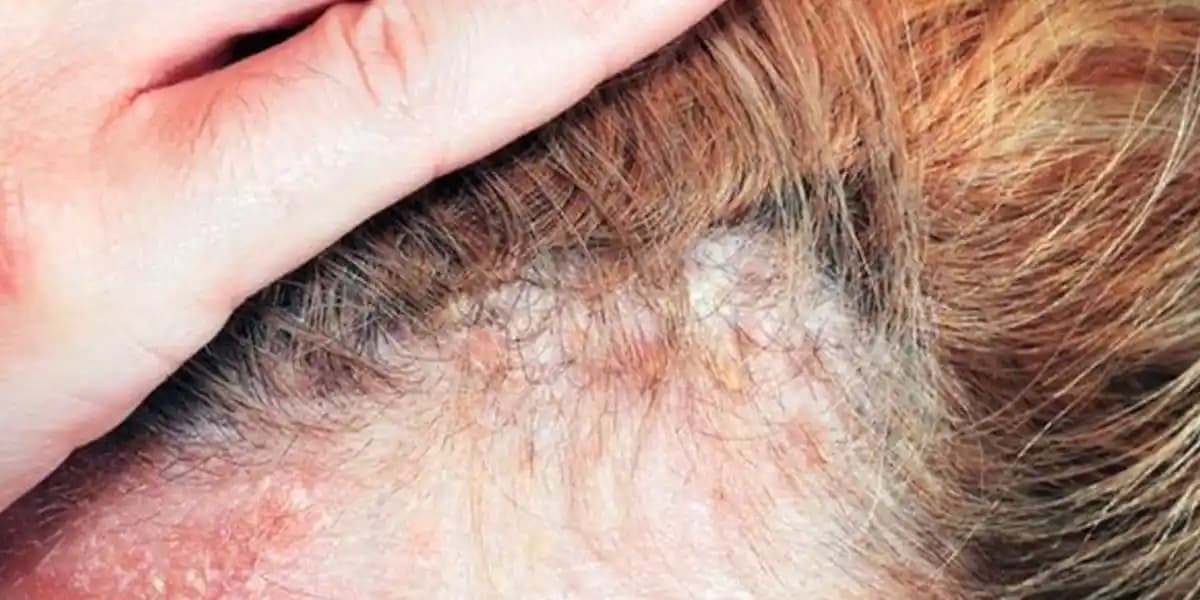 Saç Derisinde Yara Oluşumu ve Korunma Yöntemleri: Nedenleri ve Tedavi Seçenekleri