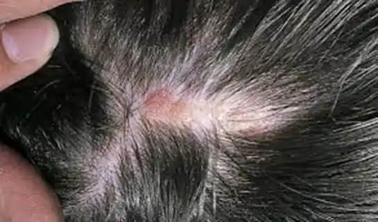 Saç Derisinde Yara Oluşumunun Nedenleri ve Saç Sağlığını Koruma Yöntemleri