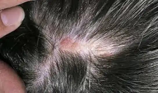 Saç Derisinde Yara Oluşumunun Nedenleri ve Saç Sağlığını Koruma Yöntemleri