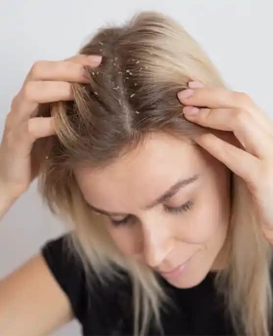Saç Derisinin Kalkması Nedenleri, Belirtileri ve Etkili Çözüm Yolları