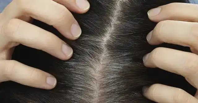 Saç Dibi Egzaması Nedir, Belirtileri ve Etkili Bakım Yöntemleri