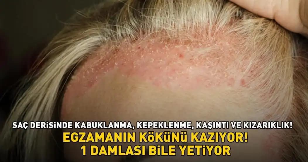 Saç Dibi Kabuklanma Sorunu ve Etkili Çözüm Yolları Hakkında Detaylı Bilgi