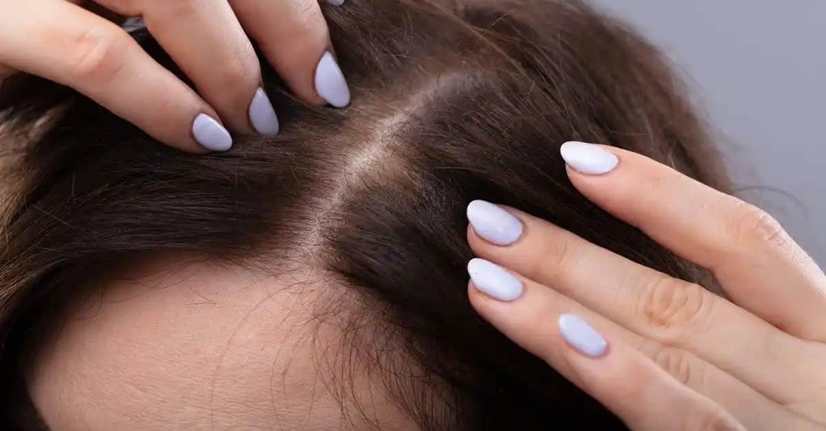 Saç Dibi Kaşıntısının Nedenleri Belirtileri ve Etkili Çözüm Yöntemleri