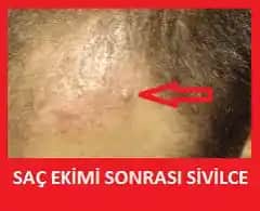 Saç Dibi Sivilceleri Nedenleri, Çözümleri ve Bakım İpuçları Hakkında Kapsamlı Rehber