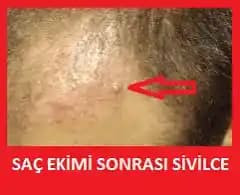 Saç Dibi Sivilceleri Nedenleri, Çözümleri ve Bakım İpuçları Hakkında Kapsamlı Rehber