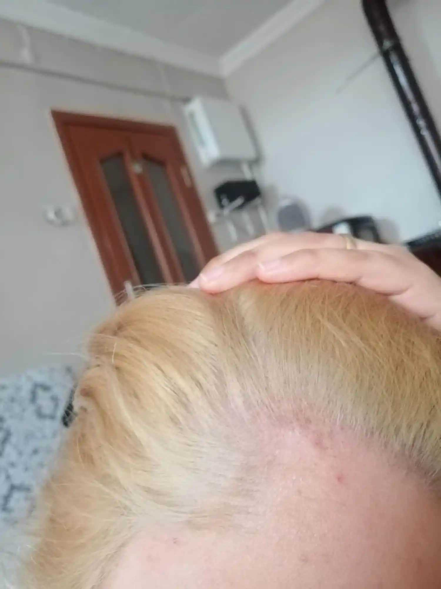 Saç Dibi Yarası ve Kozmetik Bakımın Rolü: Nedenleri ve Korunma Yöntemleri