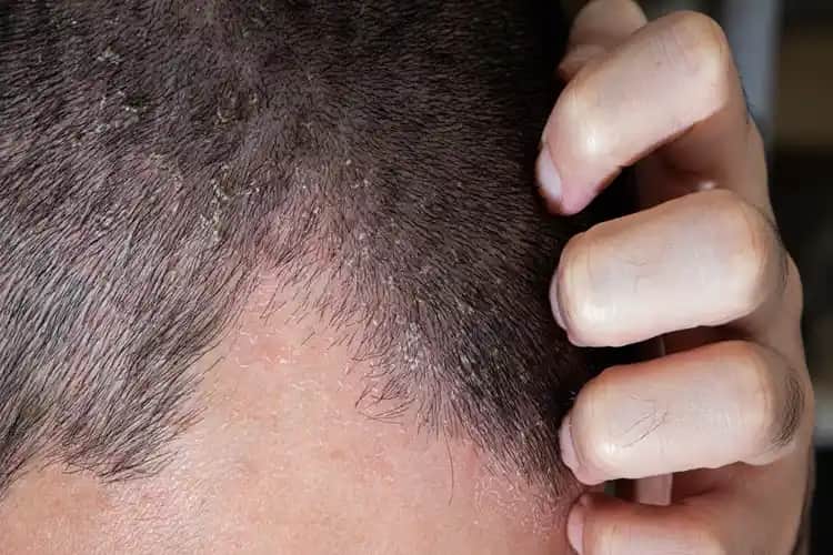 Saç Dipleri Yanması Nedenleri ve Korunma Yöntemleri Hakkında Detaylı Bilgi