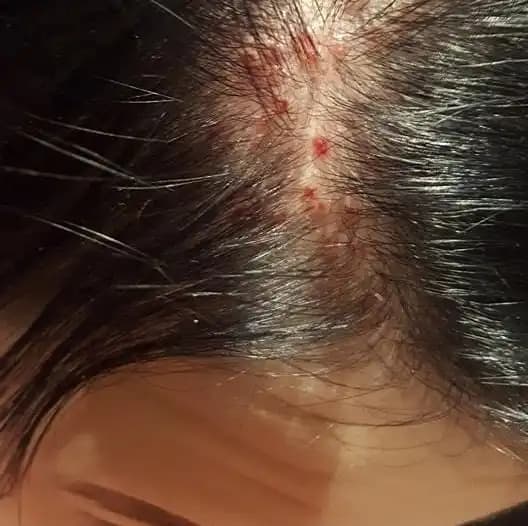 Saç Diplerindeki Kabuklanma Nedenleri, Belirtileri ve Etkili Çözüm Yolları