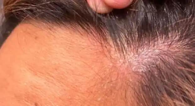 Saç Diplerindeki Sarı Kabuklanma Nedenleri ve Etkili Tedavi Yöntemleri