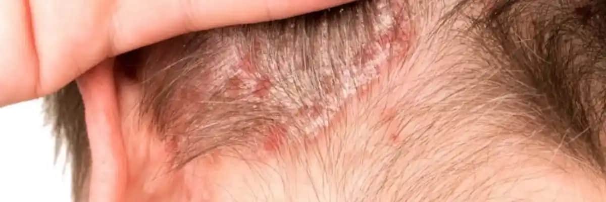 Saç Egzaması Belirtileri, Nedenleri ve Etkili Tedavi Yöntemleri Hakkında Kapsamlı Bilgi