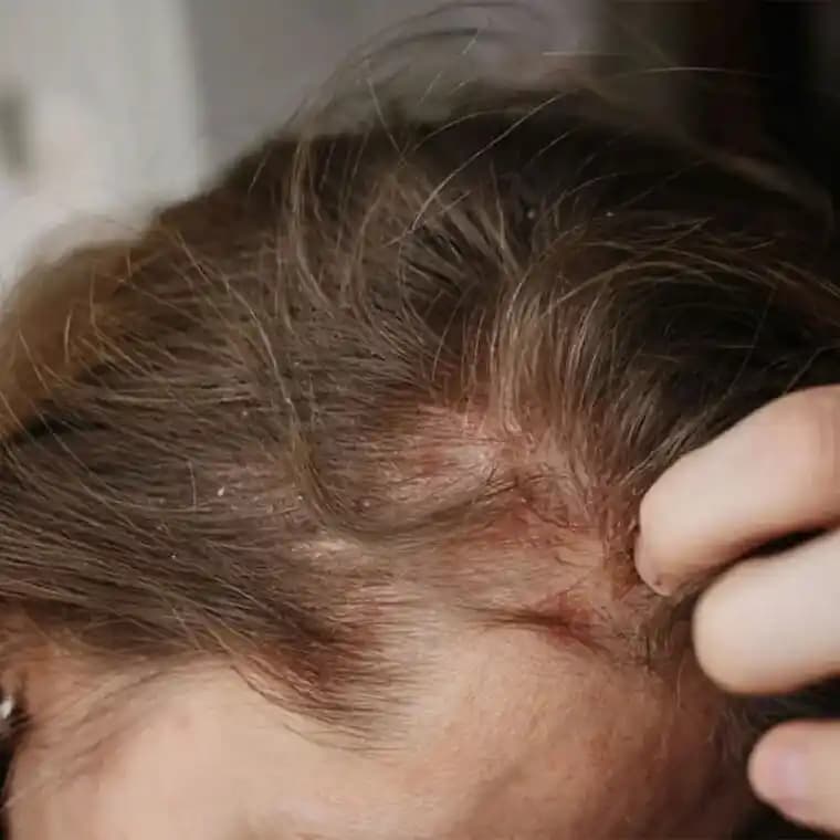 Saç Egzaması Nedenleri Belirtileri ve Etkili Tedavi Yöntemleri Hakkında Detaylı Bilgi