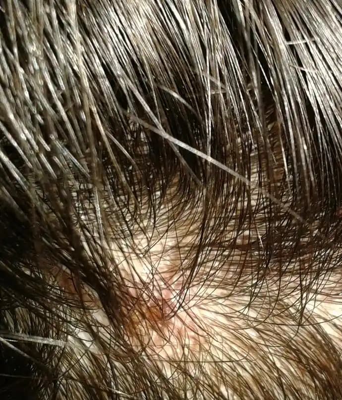 Saç İçi Yaraların Nedenleri, Belirtileri ve Etkili Bakım Yöntemleri