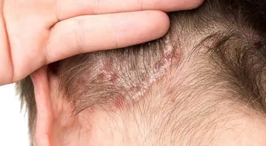 Saç Kabuklanması Nedenleri ve Etkili Önleme Yöntemleri Hakkında Kapsamlı Rehber