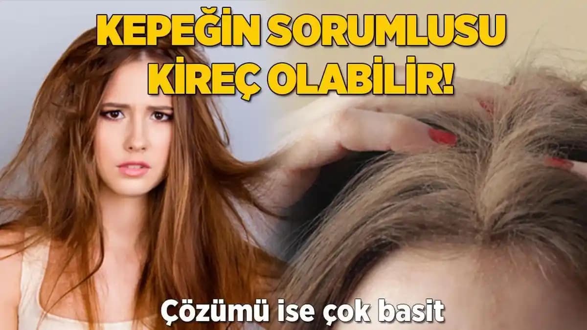 Saç Kabuklanmasına Çözüm: Sağlıklı Saçlar İçin Bilinmesi Gerekenler ve Bakım Yöntemleri