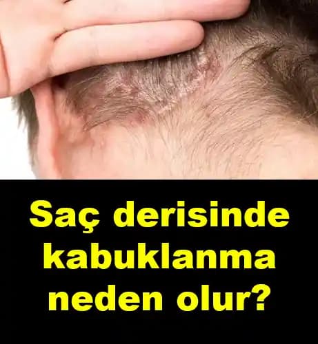 Saç Kabuklanmasının Nedenleri ve Etkili Çözüm Yolları Hakkında Detaylı Bilgi
