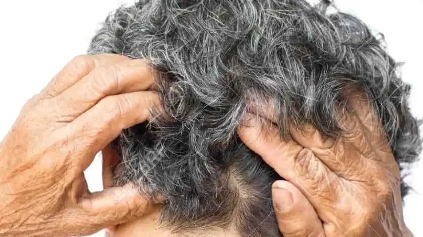 Saç Kaşıntısının Nedenleri ve Etkili Çözüm Yolları