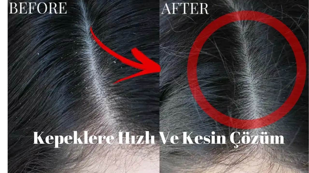 Saç Kepeğinden Kurtulma Yöntemleri ve Sağlıklı Saçlar İçin İpuçları