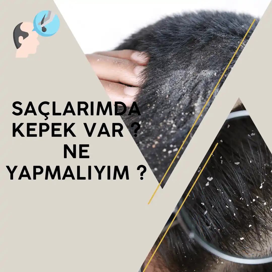 Saç Kepeğine Karşı Etkili Çözümler ve Saç Sağlığını Koruma Yöntemleri