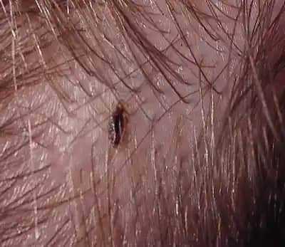 Saç Neden Bitlenir ve Bitlenmeyle Mücadelede Etkili Yöntemler Nelerdir