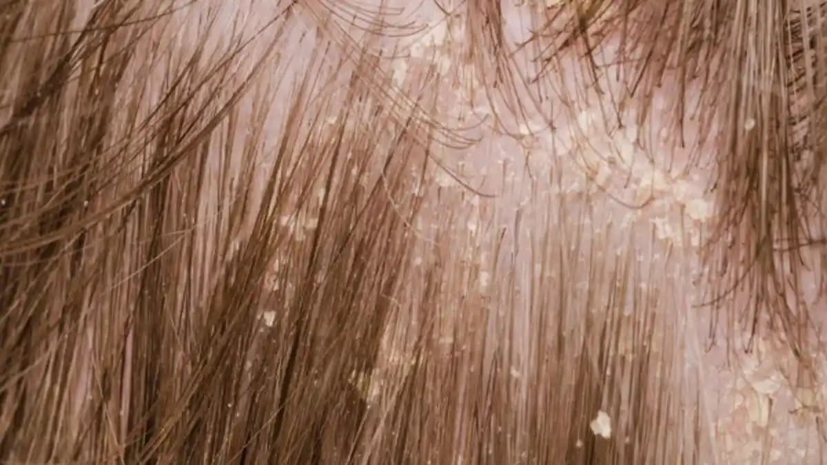 Saç Nezlesi Nedir, Belirtileri ve Doğal Tedavi Yöntemleri Hakkında Bilgiler