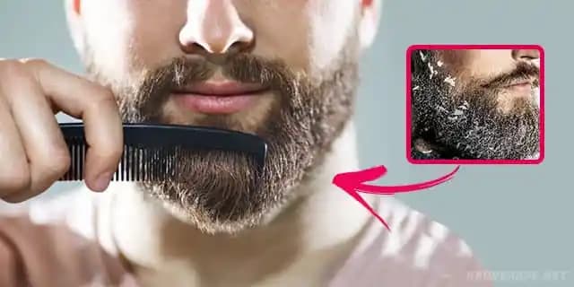 Saç ve Sakalda Kepeklenme Nedenleri, Etkileri ve Etkili Çözüm Yöntemleri