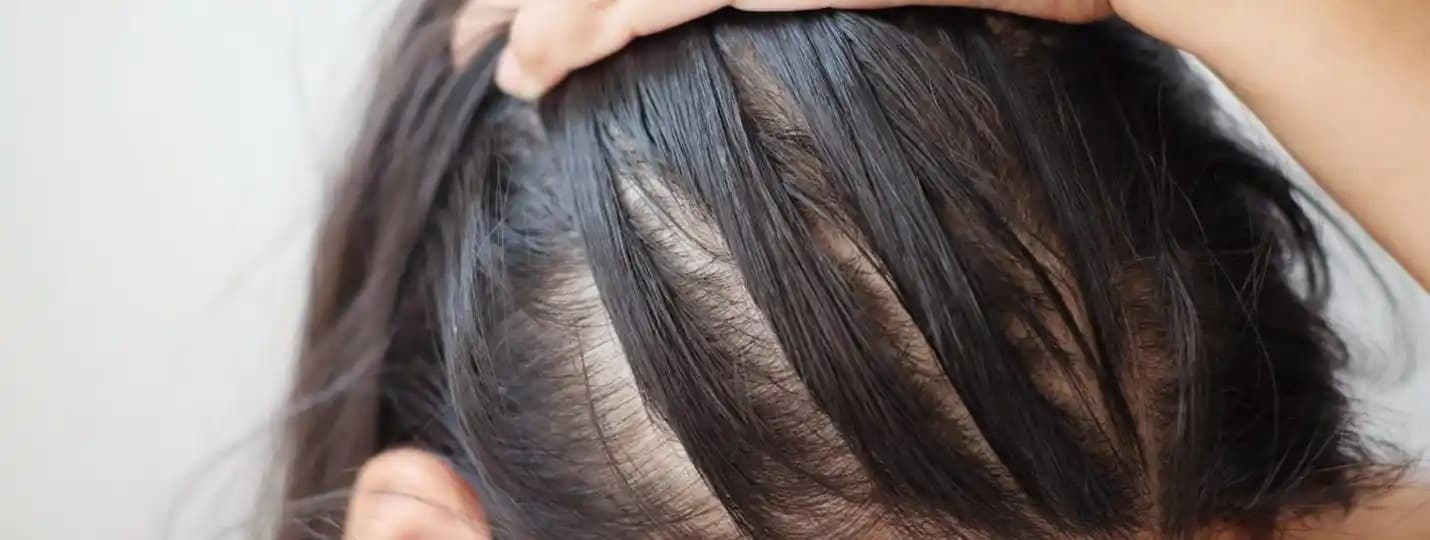 Saç Yağlanmasının Nedenleri ve Etkili Çözüm Yolları İçin Kapsamlı Rehber