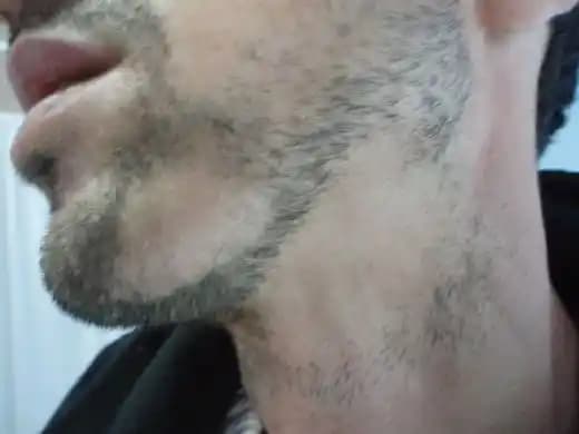 Saçkıran Sakal Nedir, Belirtileri ve Etkili Bakım Yöntemleri