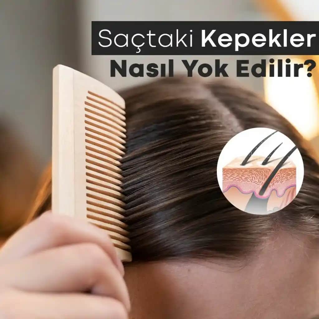 Saçlarda Kabuklanma Nedenleri, Belirtileri ve Etkili Çözüm Yöntemleri