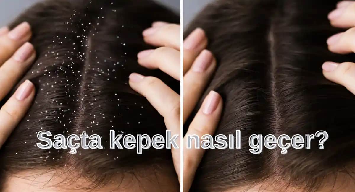 Saçlarda Kepek Neden Olur ve Etkili Çözüm Yolları Hakkında Detaylı Bilgi
