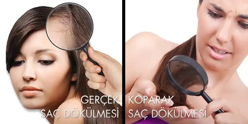 Saçların Dipten Koparak Dökülmesinin Nedenleri ve Etkili Çözüm Yöntemleri