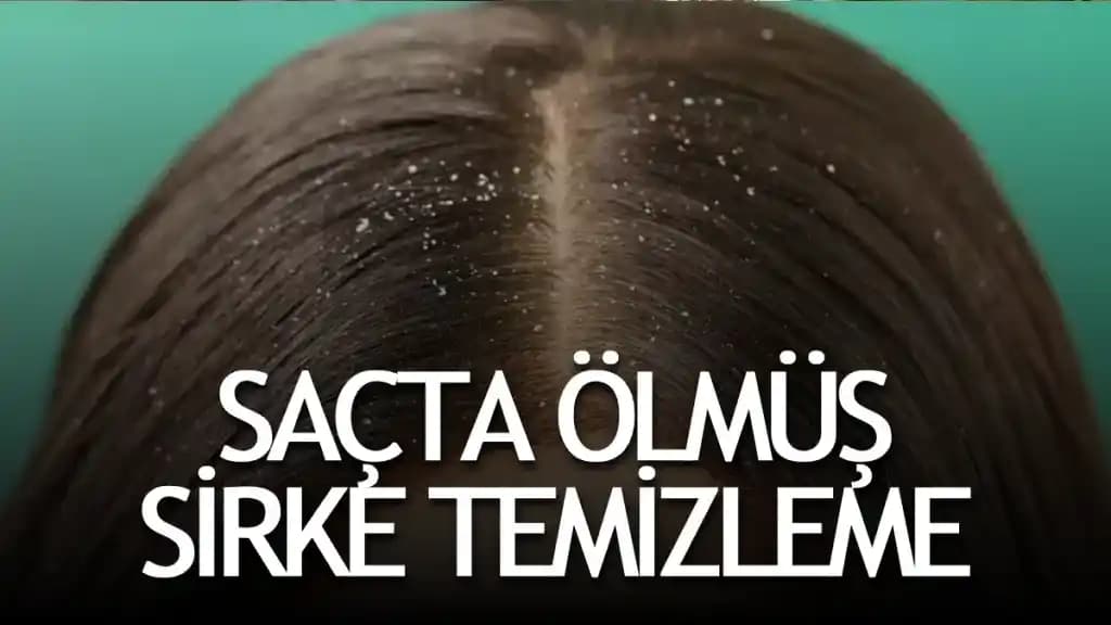 Saçta Bit Resmi Nedir Belirtileri ve Doğal Mücadele Yöntemleri Hakkında Bilgi