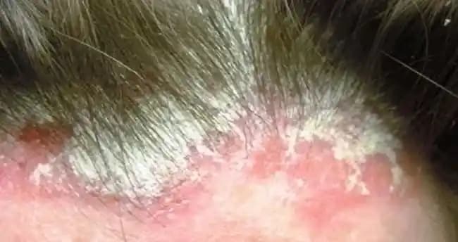 Saçta Dermatite Karşı Etkili Yönetim ve Koruma Yöntemleri Rehberi