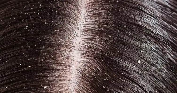 Saçta Kabuklanma Nedenleri, Çözüm Yolları ve Koruma İpuçları