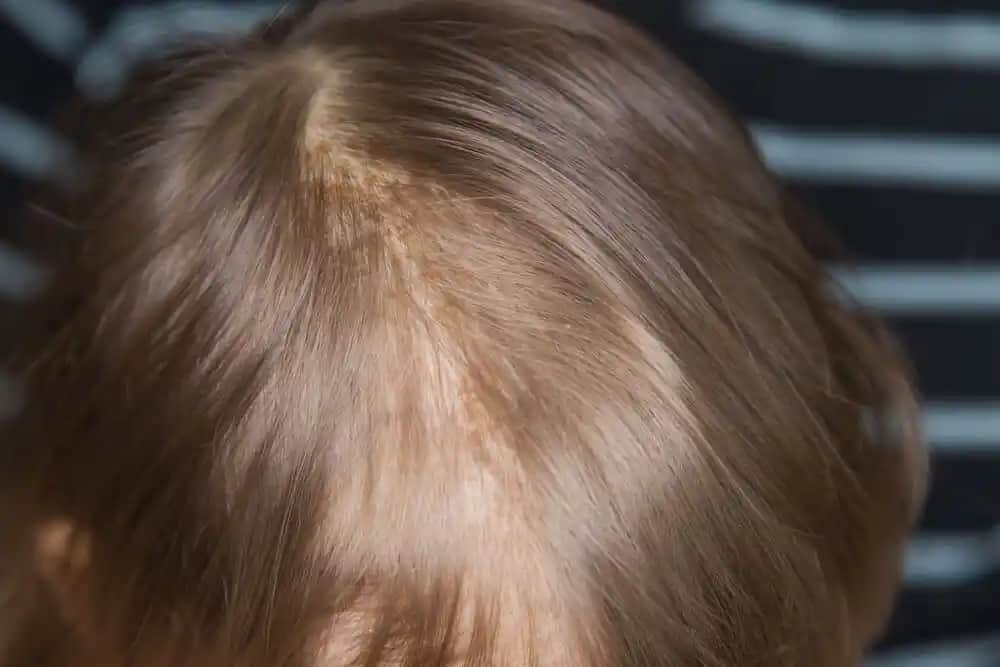 Saçta Konak Tedavisi: Modern ve Doğal Yaklaşımlarla Saç Sağlığını Koruma Yöntemleri