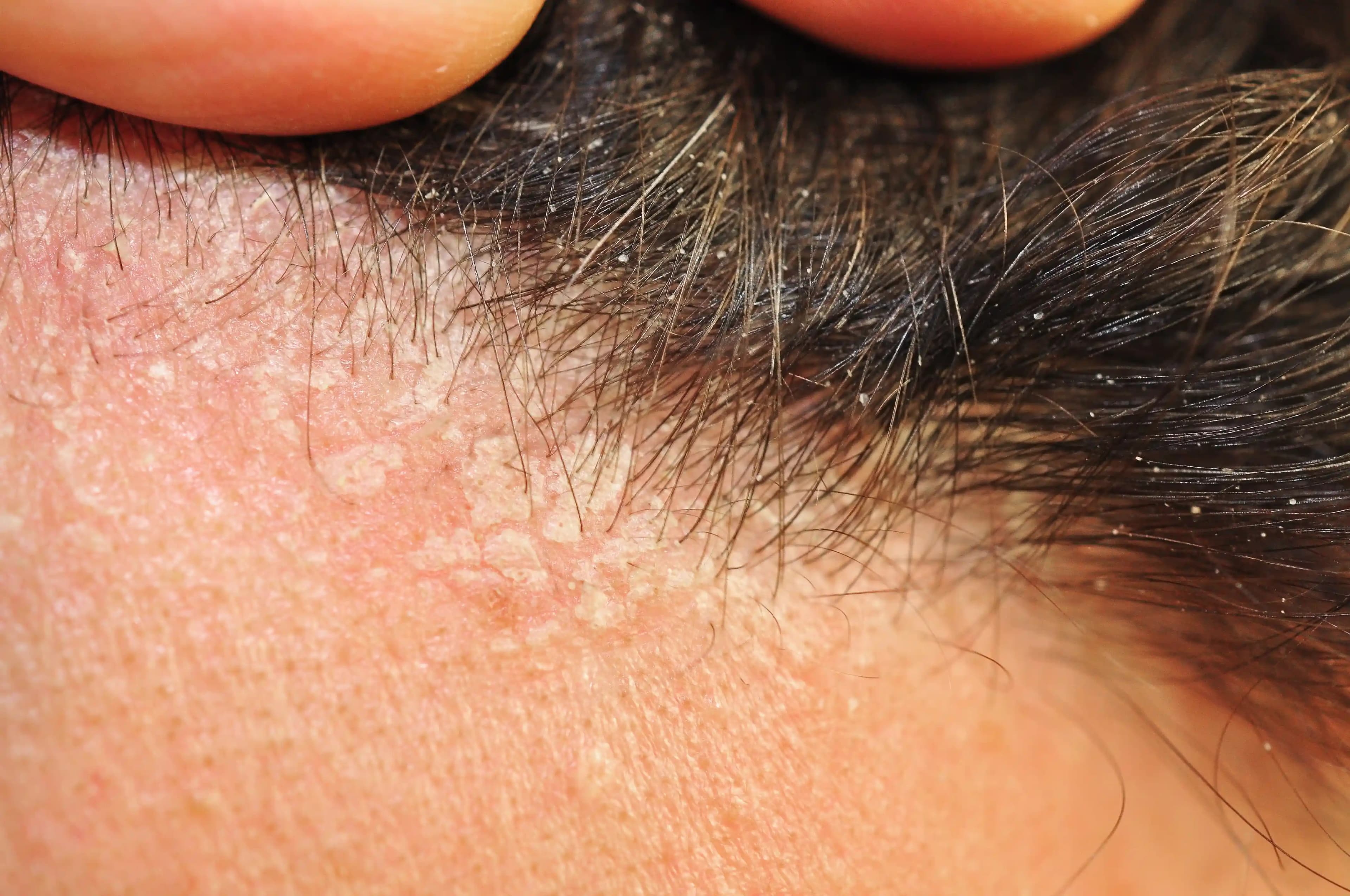 Saçta Seboreik Dermatitle Mücadele Yolları: Kozmetik ve Doğal Yaklaşımlar