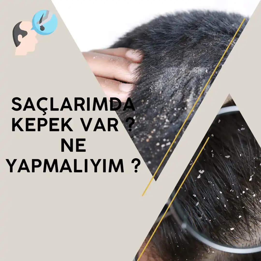 Saçtaki Kepekle Mücadele Yolları ve Etkili Çözüm Tavsiyeleri
