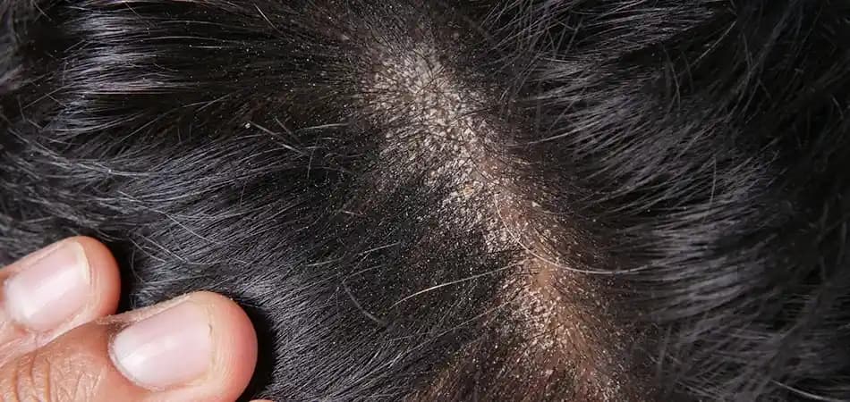 Saçtaki Sivilceler: Nedenleri, Çözüm Yöntemleri ve Bakım İpuçları