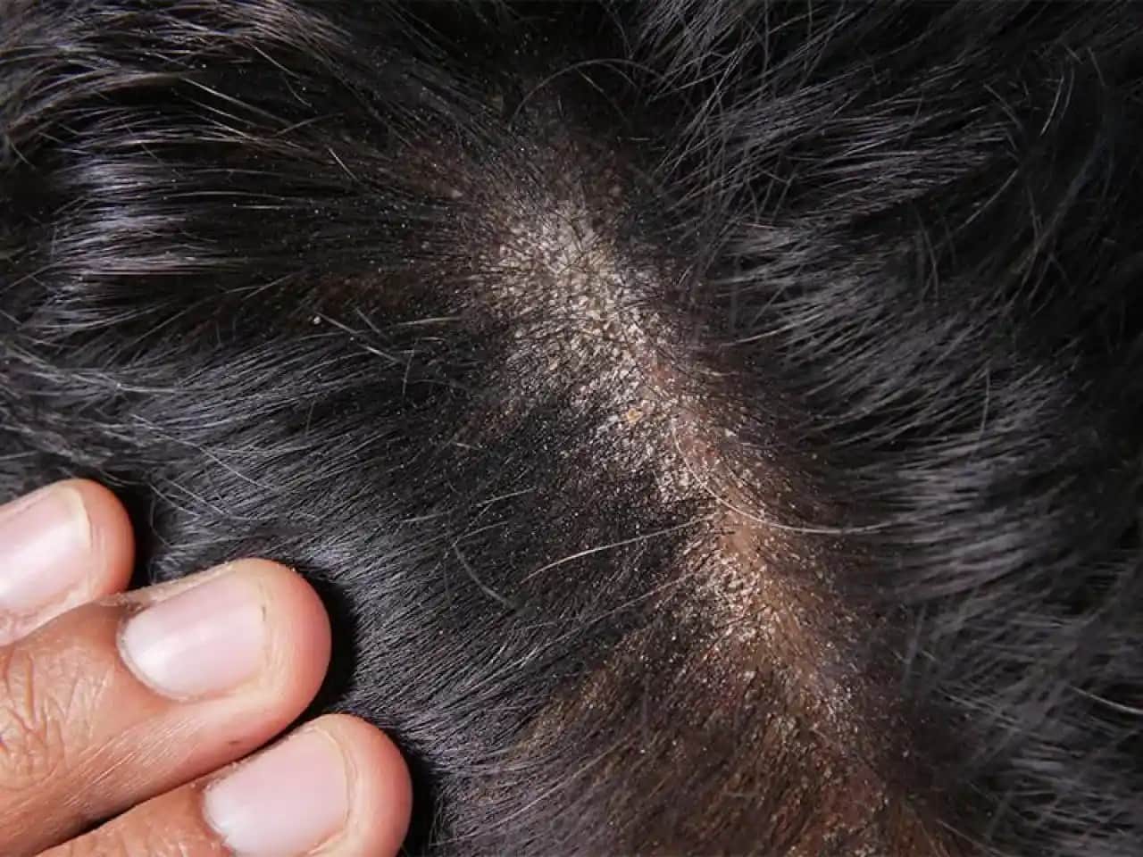 Sakal Kepeği Nedenleri ve Doğal Çözüm Yöntemleri ile Sağlıklı Sakallar