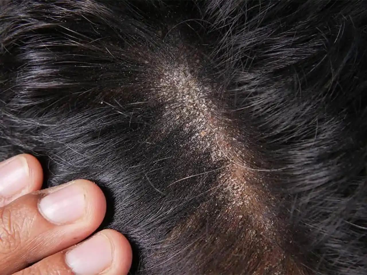 Sakal Kepeği Nedenleri ve Doğal Çözüm Yöntemleri ile Sağlıklı Sakallar