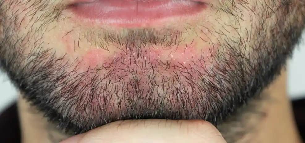 Sakal Kepeklenmesinin Nedenleri ve Etkili Bakım Yöntemleri Hakkında Bilgiler