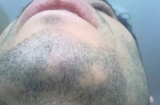 Sakal Kıran Nedir, Nedenleri ve İyileşme Sürecinde Dikkat Edilmesi Gerekenler