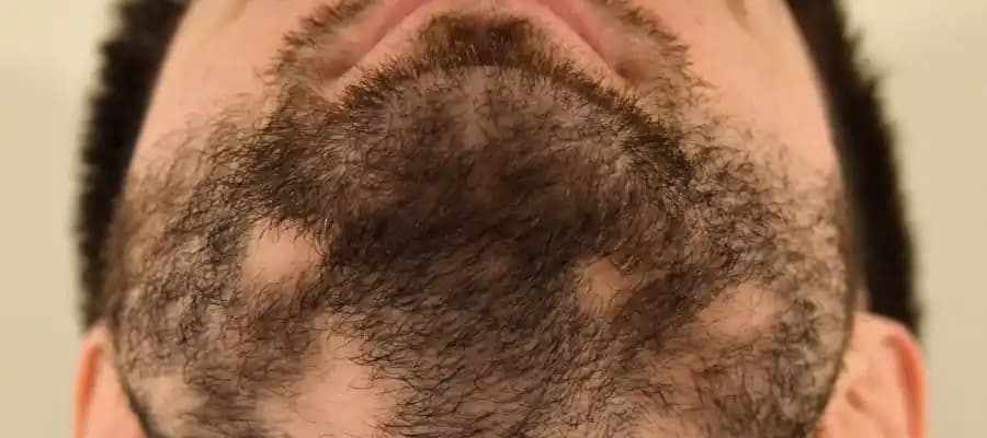 Sakal Kırıklarının Nedenleri ve Etkili Bakım Yöntemleri Hakkında Kapsamlı Rehber