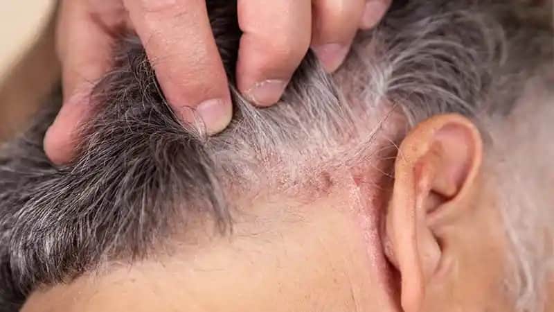 Seboreik Dermatitin Saç Dökülmesiyle İlişkisi ve Saç Sağlığını Koruma Yöntemleri