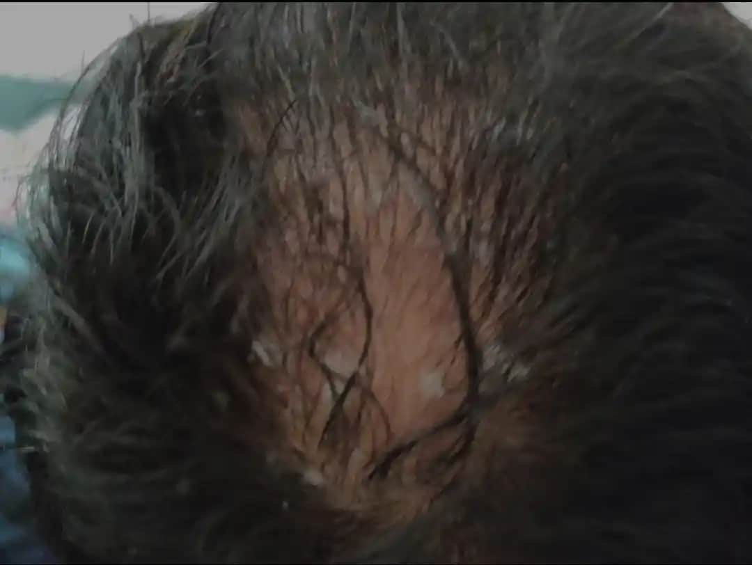 Seboreik Dermatitle Dökülen Saçlar Tekrar Çıkar mı Uzman Görüşleri ve Tedavi Yöntemleri