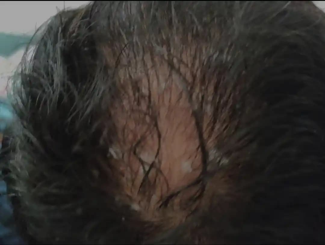 Seboreik Dermatitle Dökülen Saçlar Tekrar Çıkar mı Uzman Görüşleri ve Tedavi Yöntemleri