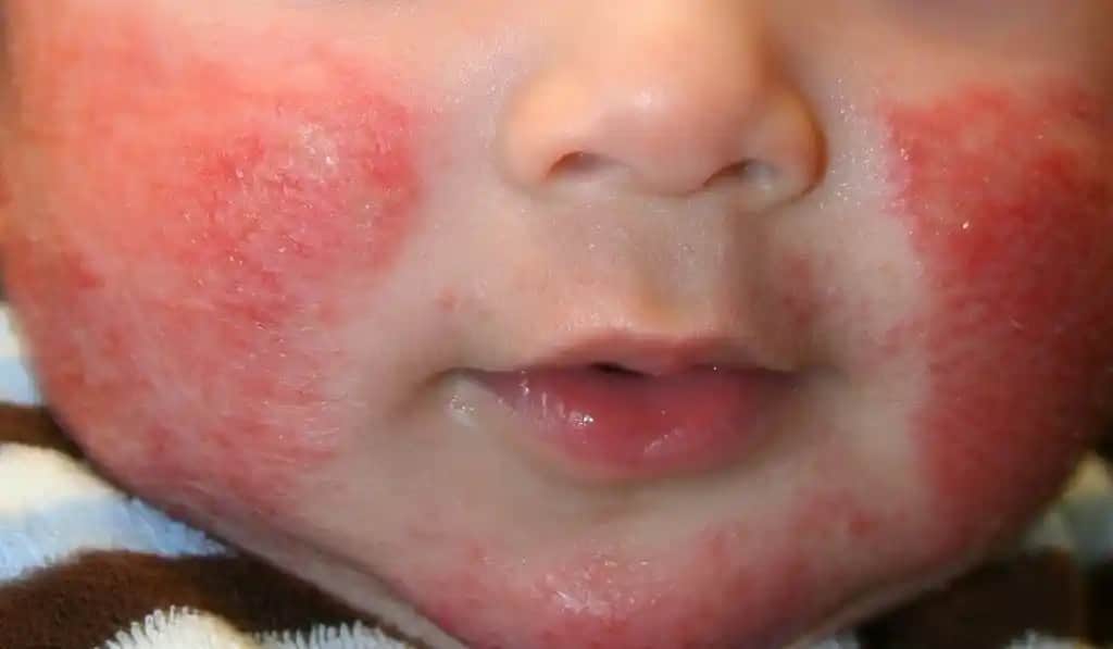 Seboreik Dermatitle Mücadelede Beslenme İpuçları ve Cilt Sağlığı Önerileri