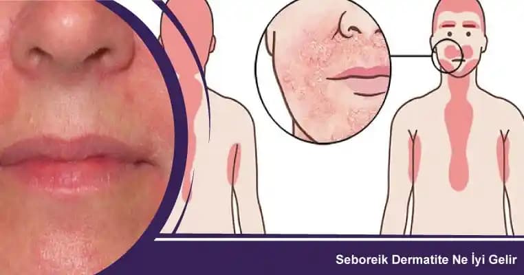 Seboreik Dermatitte Kozmetik Yaklaşımlar ve Cilt Bakım Önerileri