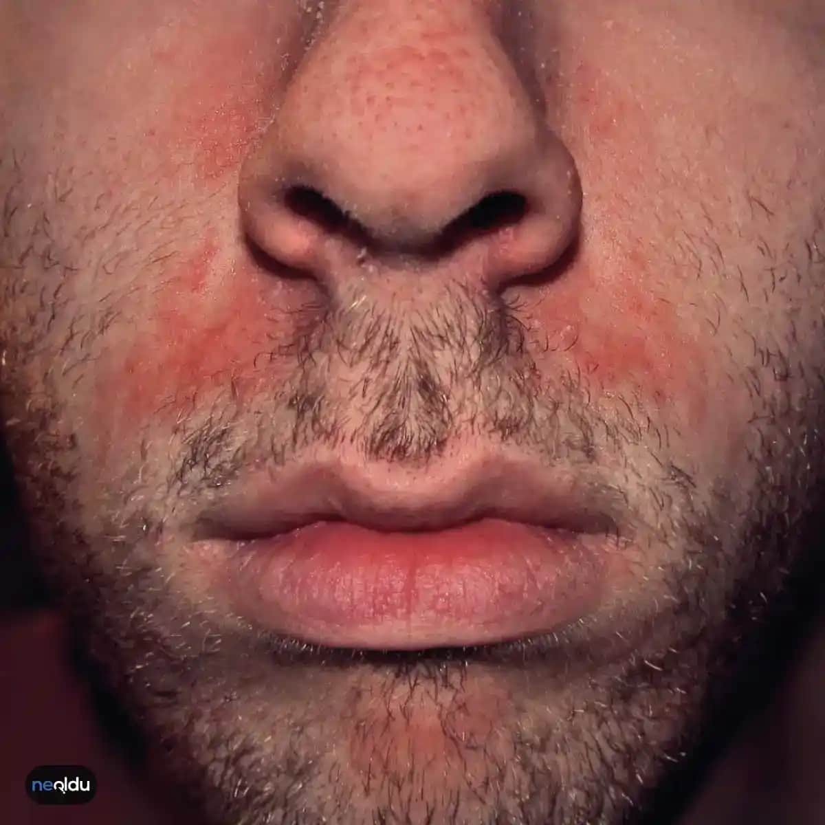 Seboreik Egzama Nedir, Belirtileri ve Doğal Çözüm Yöntemleri Hakkında Bilgi