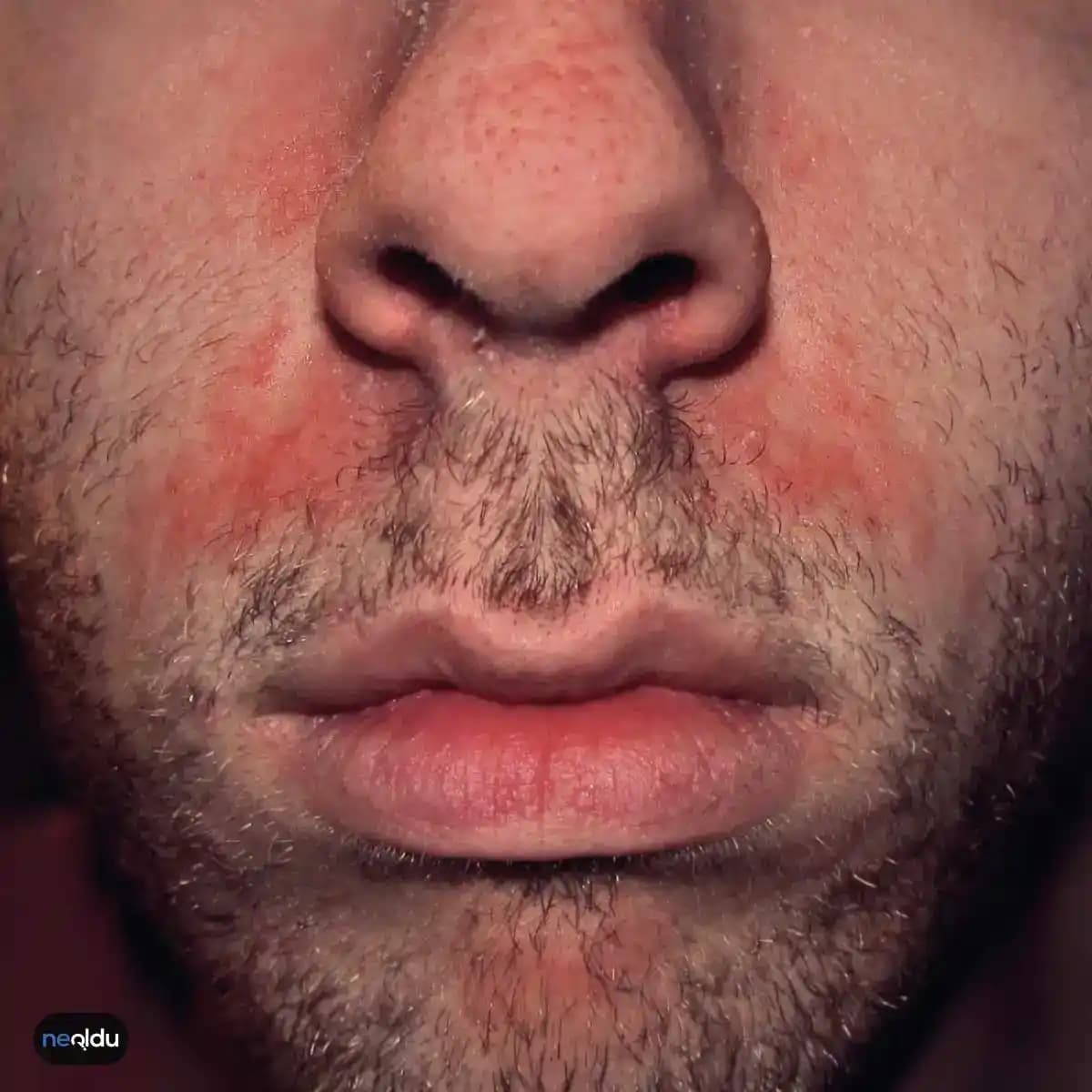 Seboreik Egzama Nedir, Belirtileri ve Doğal Çözüm Yöntemleri Hakkında Bilgi